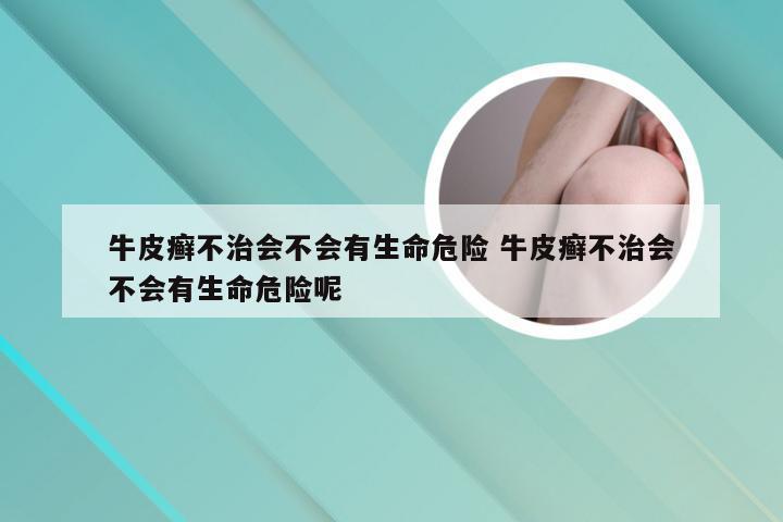 牛皮癣不治会不会有生命危险 牛皮癣不治会不会有生命危险呢