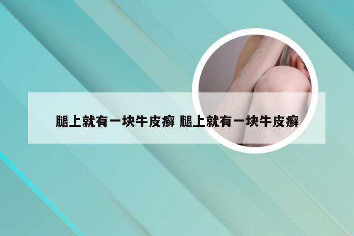 腿上就有一块牛皮癣 腿上就有一块牛皮癣