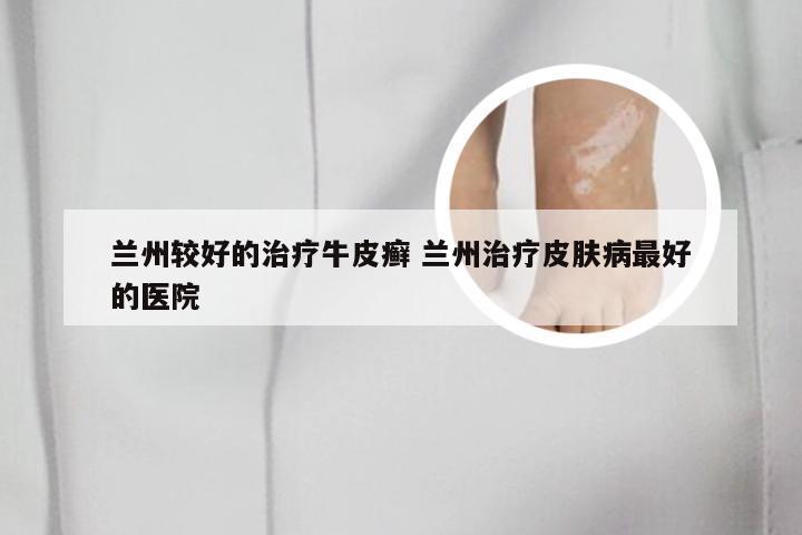 兰州较好的治疗牛皮癣 兰州治疗皮肤病最好的医院