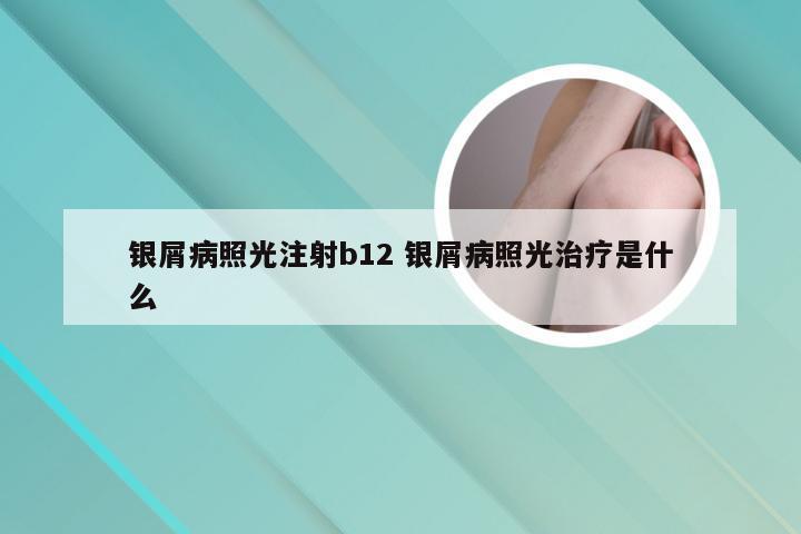 银屑病照光注射b12 银屑病照光治疗是什么