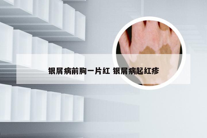 银屑病前胸一片红 银屑病起红疹