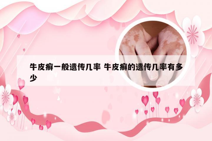 牛皮癣一般遗传几率 牛皮癣的遗传几率有多少