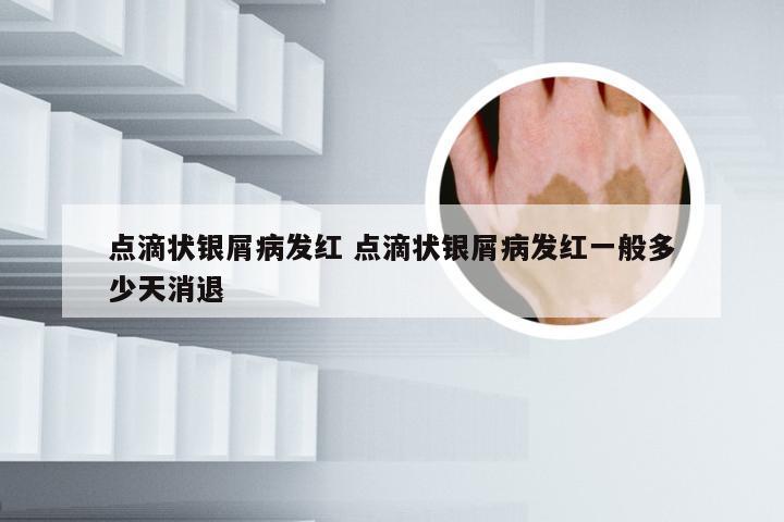 点滴状银屑病发红 点滴状银屑病发红一般多少天消退