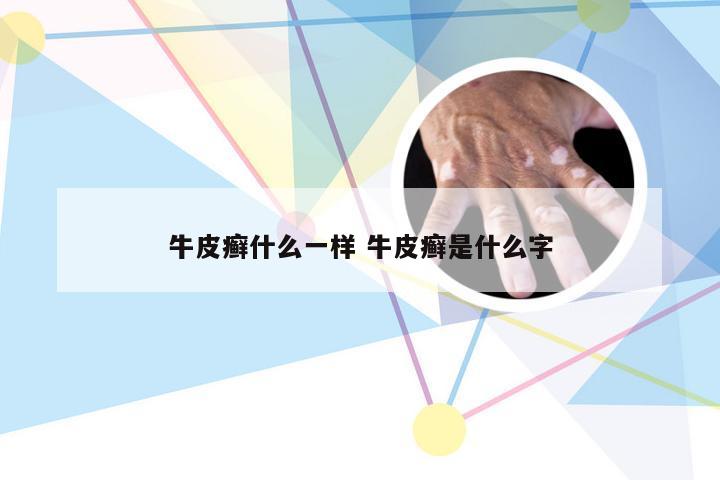 牛皮癣什么一样 牛皮癣是什么字