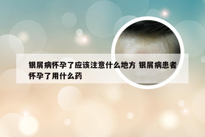 银屑病怀孕了应该注意什么地方 银屑病患者怀孕了用什么药