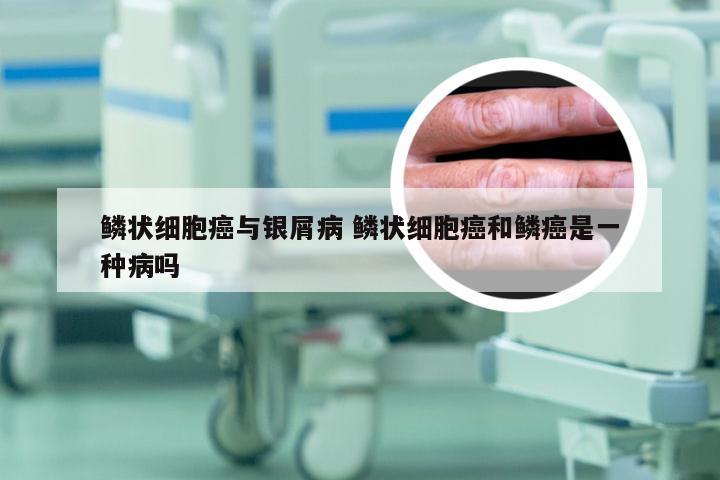 鳞状细胞癌与银屑病 鳞状细胞癌和鳞癌是一种病吗