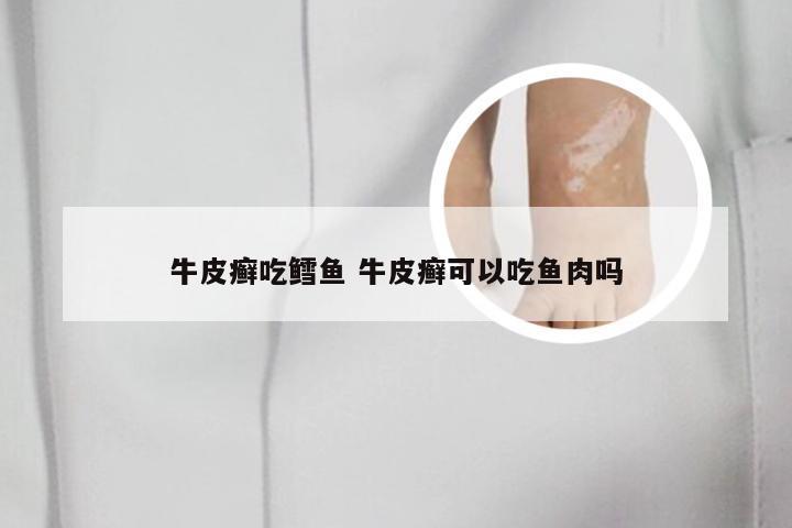 牛皮癣吃鳕鱼 牛皮癣可以吃鱼肉吗