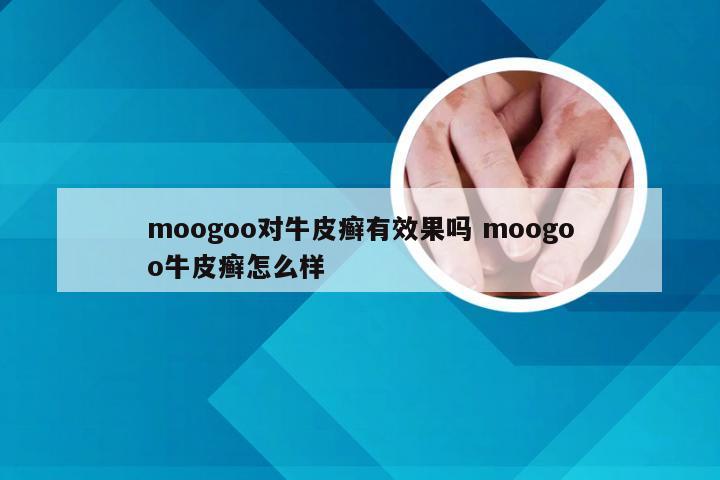 moogoo对牛皮癣有效果吗 moogoo牛皮癣怎么样