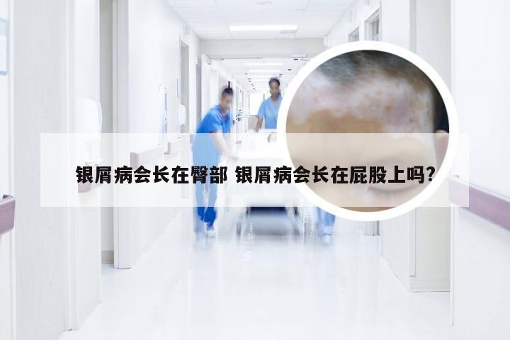 银屑病会长在臀部 银屑病会长在屁股上吗?