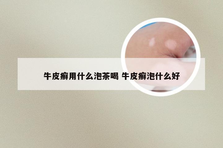 牛皮癣用什么泡茶喝 牛皮癣泡什么好