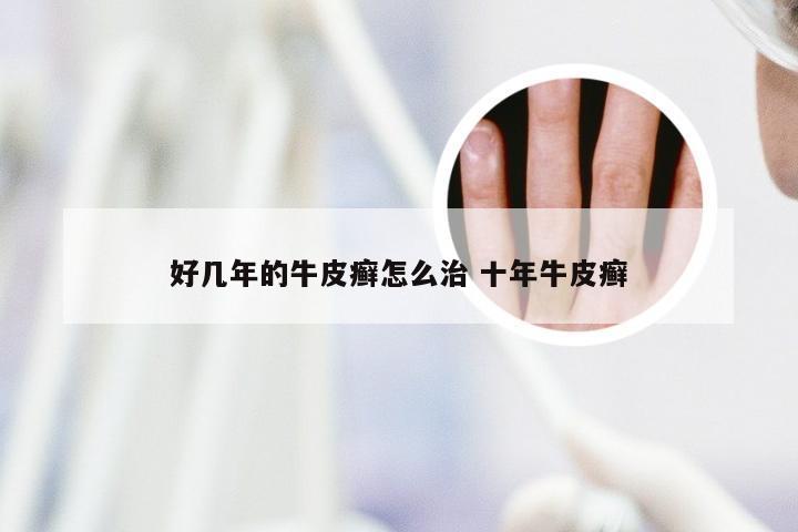 好几年的牛皮癣怎么治 十年牛皮癣