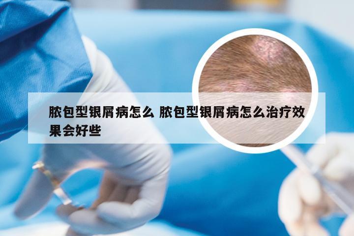 脓包型银屑病怎么 脓包型银屑病怎么治疗效果会好些