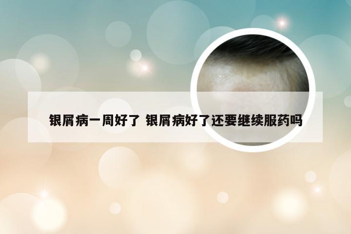 银屑病一周好了 银屑病好了还要继续服药吗