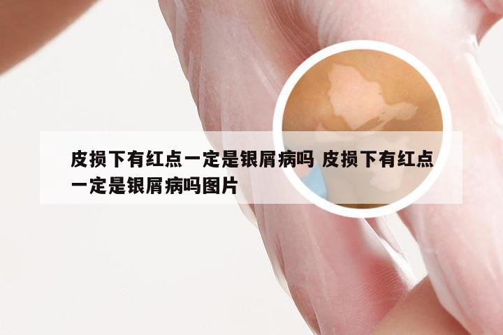 皮损下有红点一定是银屑病吗 皮损下有红点一定是银屑病吗图片