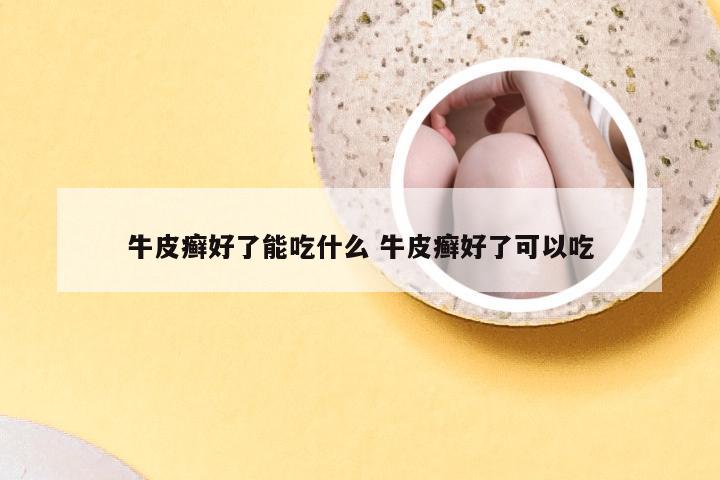 牛皮癣好了能吃什么 牛皮癣好了可以吃