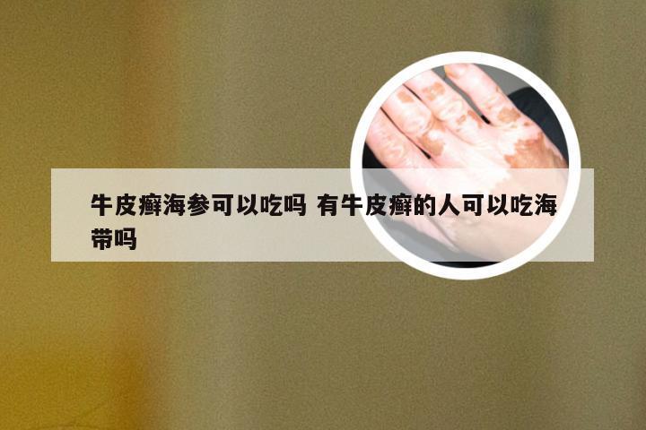 牛皮癣海参可以吃吗 有牛皮癣的人可以吃海带吗
