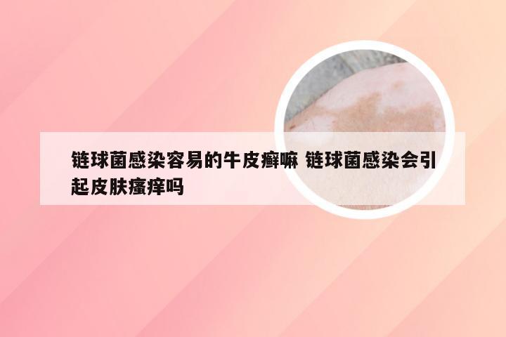 链球菌感染容易的牛皮癣嘛 链球菌感染会引起皮肤瘙痒吗
