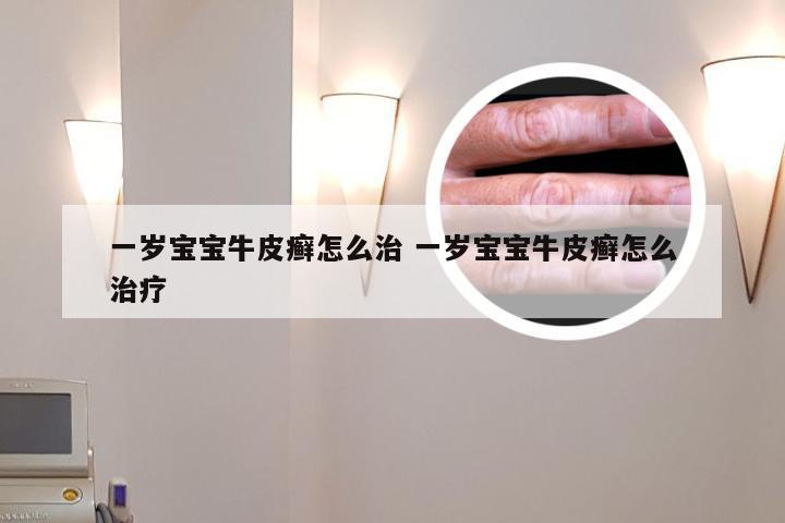 一岁宝宝牛皮癣怎么治 一岁宝宝牛皮癣怎么治疗