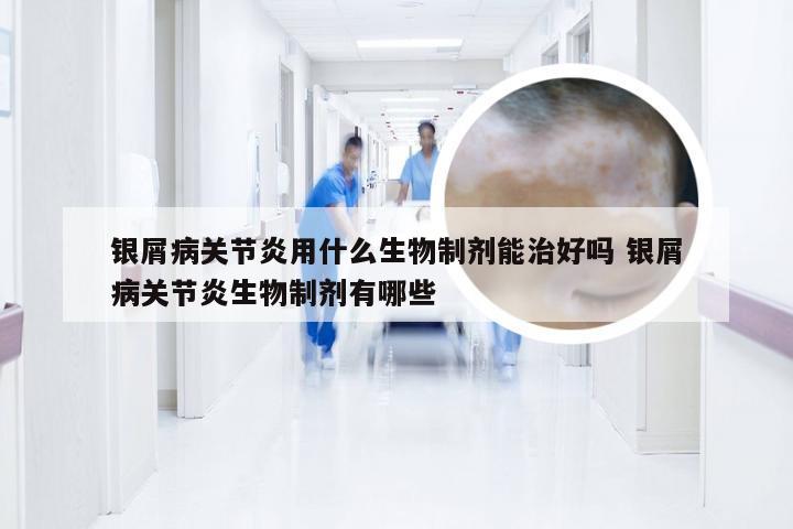 银屑病关节炎用什么生物制剂能治好吗 银屑病关节炎生物制剂有哪些