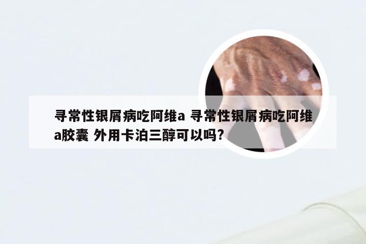 寻常性银屑病吃阿维a 寻常性银屑病吃阿维a胶囊 外用卡泊三醇可以吗?