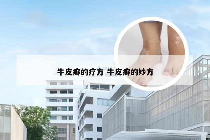 牛皮癣的疗方 牛皮癣的妙方