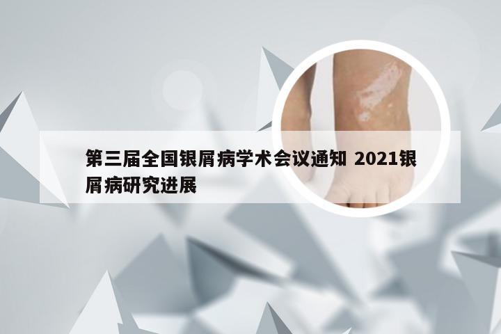 第三届全国银屑病学术会议通知 2021银屑病研究进展
