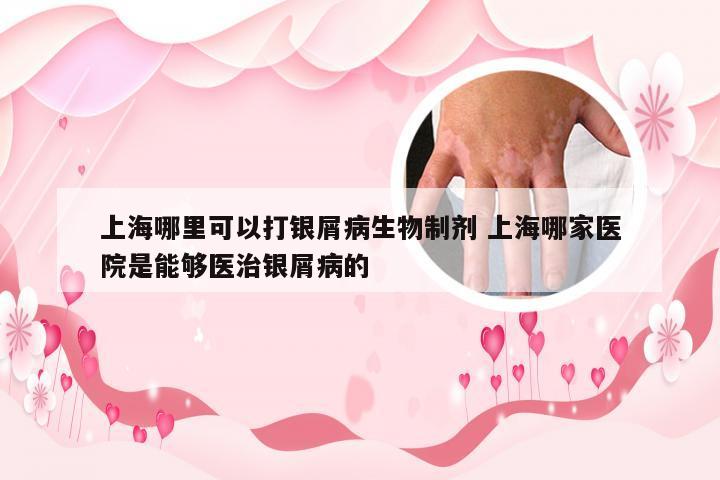 上海哪里可以打银屑病生物制剂 上海哪家医院是能够医治银屑病的