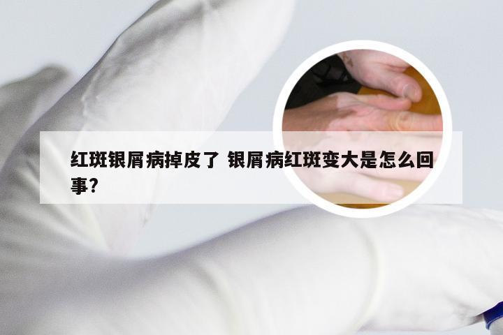 红斑银屑病掉皮了 银屑病红斑变大是怎么回事?