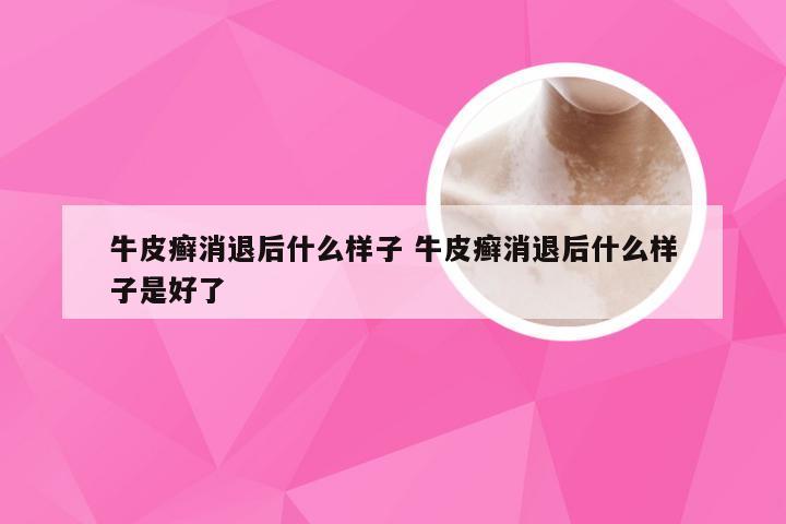 牛皮癣消退后什么样子 牛皮癣消退后什么样子是好了