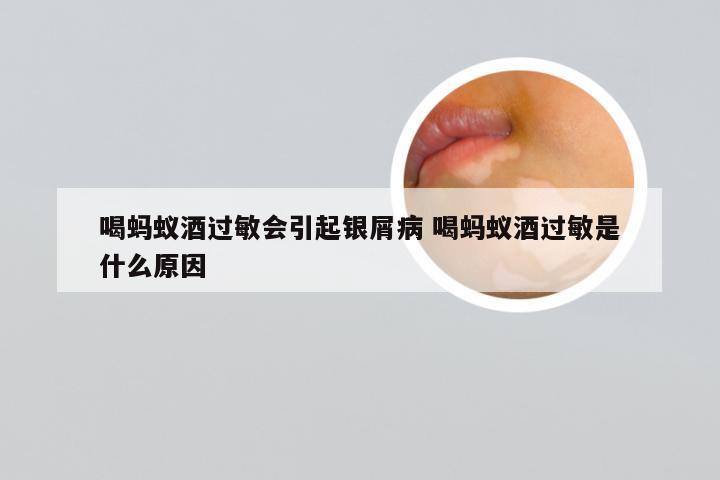 喝蚂蚁酒过敏会引起银屑病 喝蚂蚁酒过敏是什么原因