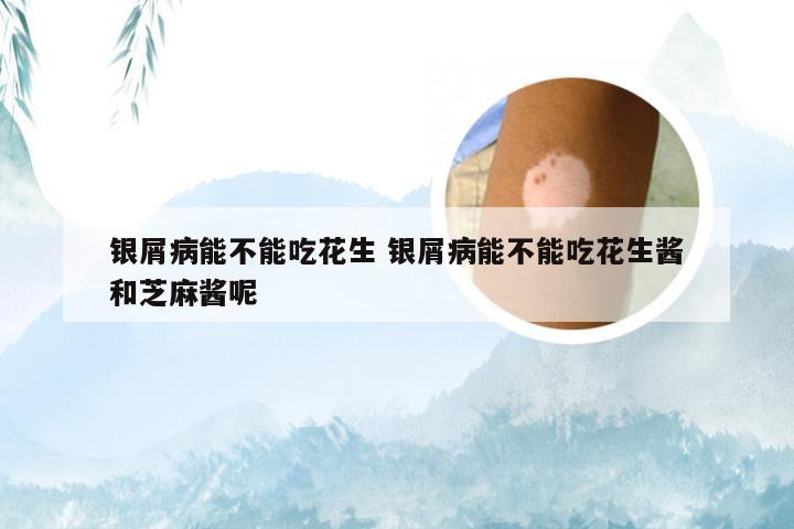 银屑病能不能吃花生 银屑病能不能吃花生酱和芝麻酱呢