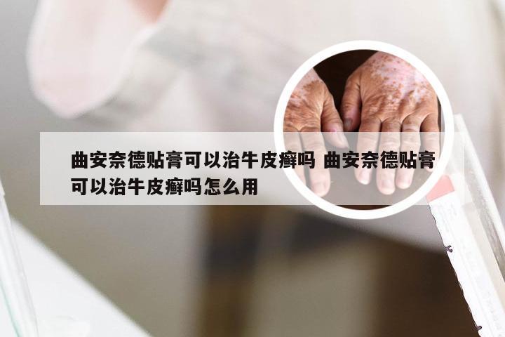 曲安奈德贴膏可以治牛皮癣吗 曲安奈德贴膏可以治牛皮癣吗怎么用