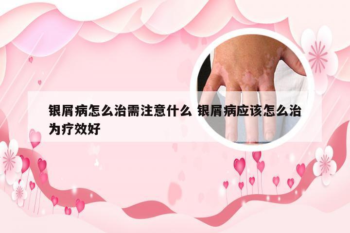 银屑病怎么治需注意什么 银屑病应该怎么治为疗效好
