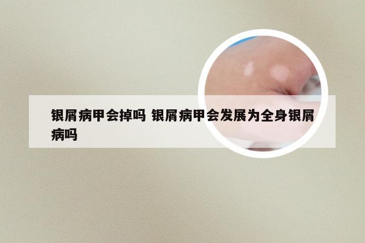 银屑病甲会掉吗 银屑病甲会发展为全身银屑病吗