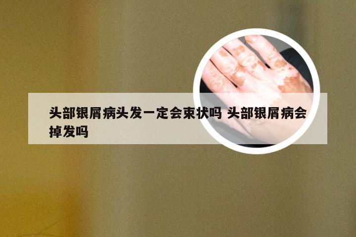头部银屑病头发一定会束状吗 头部银屑病会掉发吗