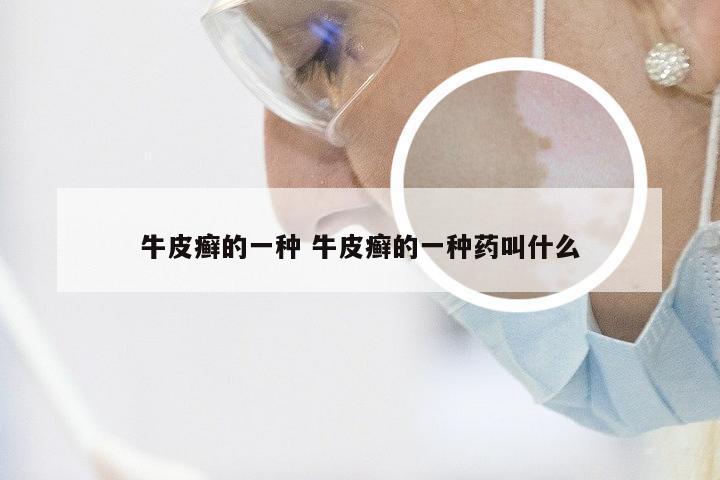牛皮癣的一种 牛皮癣的一种药叫什么