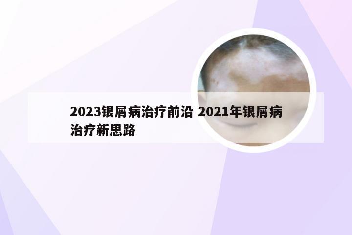 2023银屑病治疗前沿 2021年银屑病治疗新思路