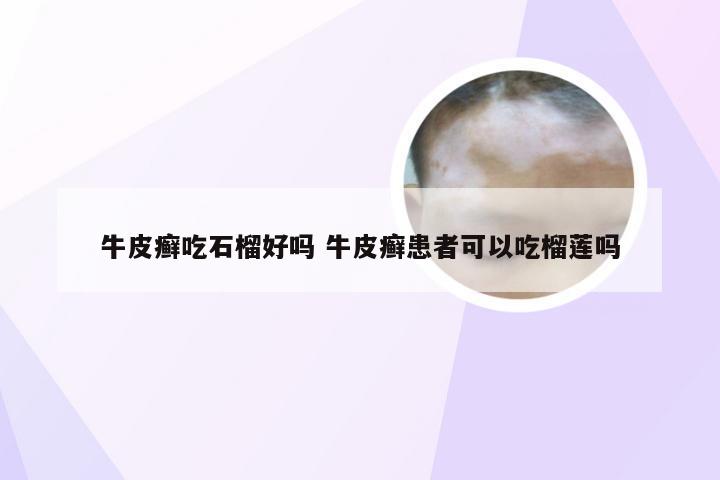 牛皮癣吃石榴好吗 牛皮癣患者可以吃榴莲吗