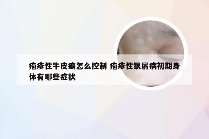 疱疹性牛皮癣怎么控制 疱疹性银屑病初期身体有哪些症状