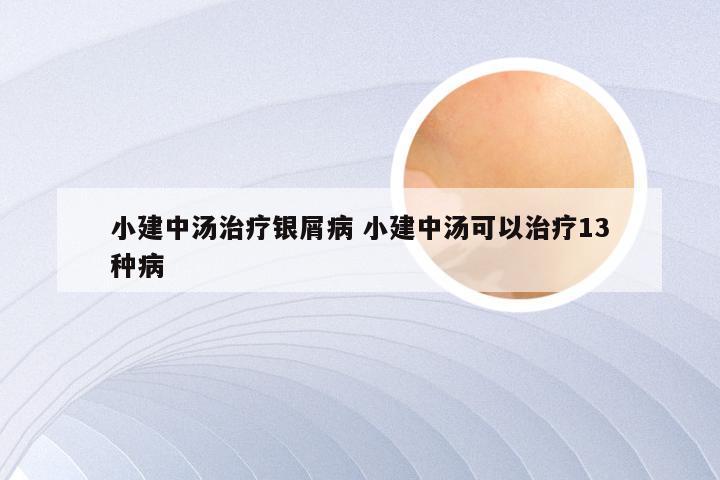 小建中汤治疗银屑病 小建中汤可以治疗13种病