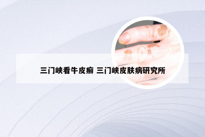 三门峡看牛皮癣 三门峡皮肤病研究所