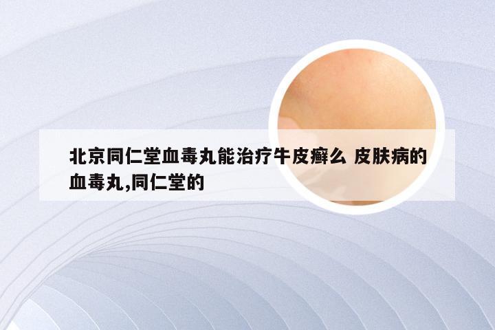 北京同仁堂血毒丸能治疗牛皮癣么 皮肤病的血毒丸,同仁堂的