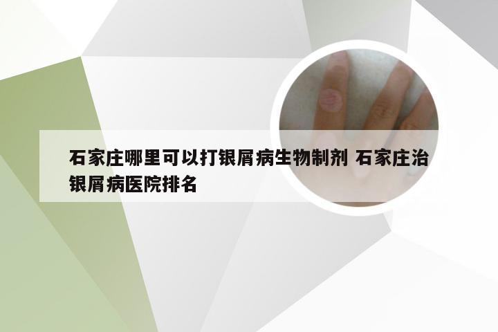 石家庄哪里可以打银屑病生物制剂 石家庄治银屑病医院排名