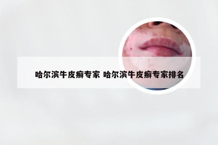 哈尔滨牛皮癣专家 哈尔滨牛皮癣专家排名