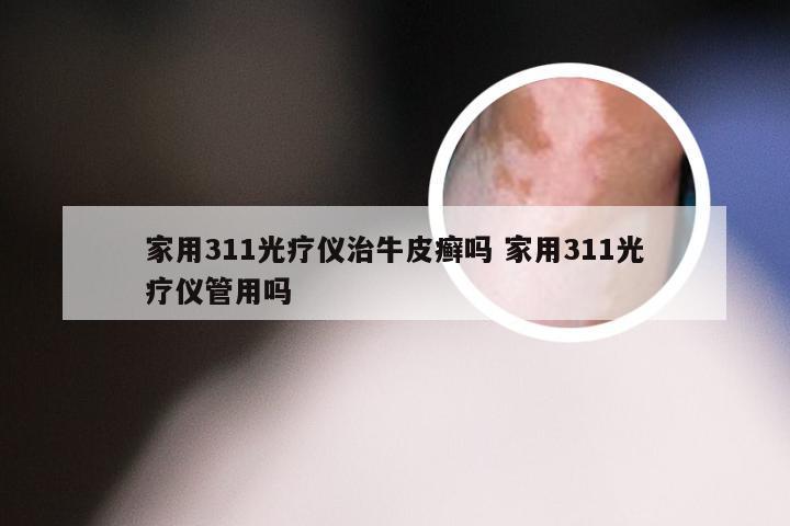 家用311光疗仪治牛皮癣吗 家用311光疗仪管用吗
