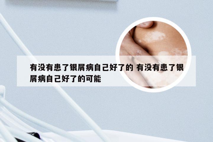 有没有患了银屑病自己好了的 有没有患了银屑病自己好了的可能