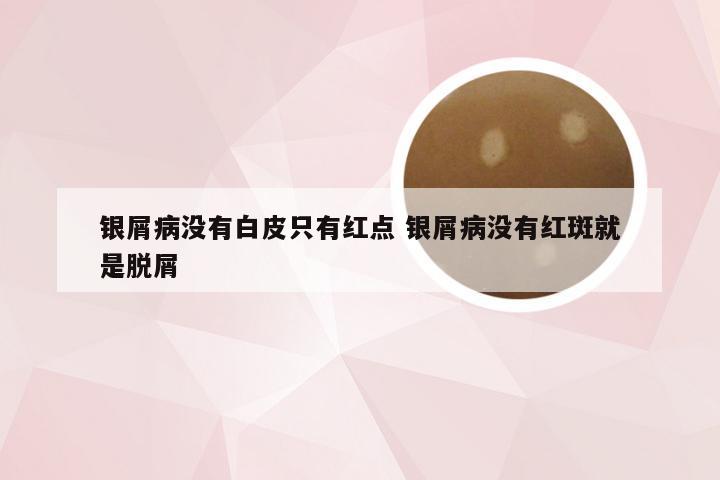 银屑病没有白皮只有红点 银屑病没有红斑就是脱屑