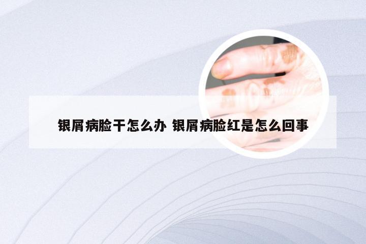 银屑病脸干怎么办 银屑病脸红是怎么回事