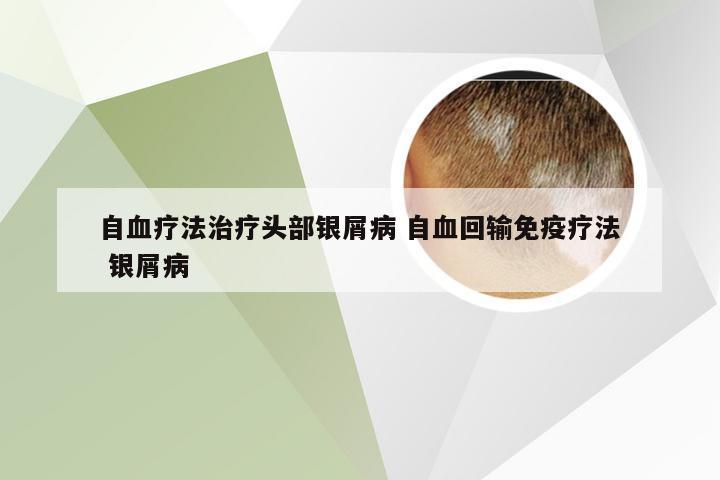 自血疗法治疗头部银屑病 自血回输免疫疗法 银屑病