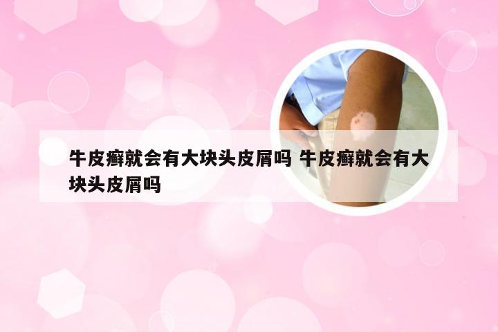 牛皮癣就会有大块头皮屑吗 牛皮癣就会有大块头皮屑吗